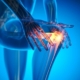 These factors (not the ones you think of) are associated with worse arthritis